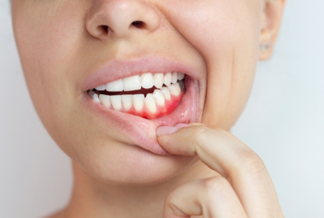 Close-up of a woman drawing down her lower lip to show a red, inflamed gum